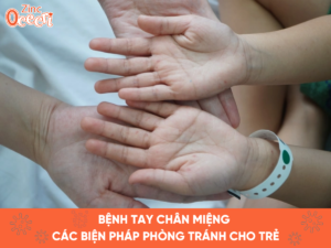 Bệnh tay chân miệng và các biện pháp phòng tránh cho trẻ
