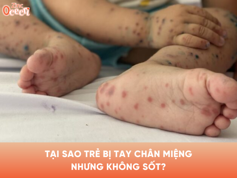 Tại sao trẻ bị tay chân miệng nhưng không sốt?