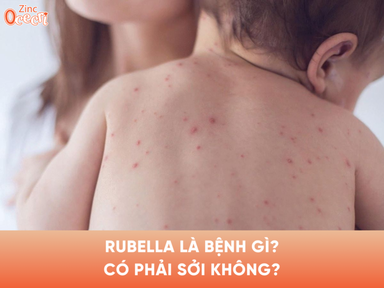 Rubella là gì? Có phải sởi không?